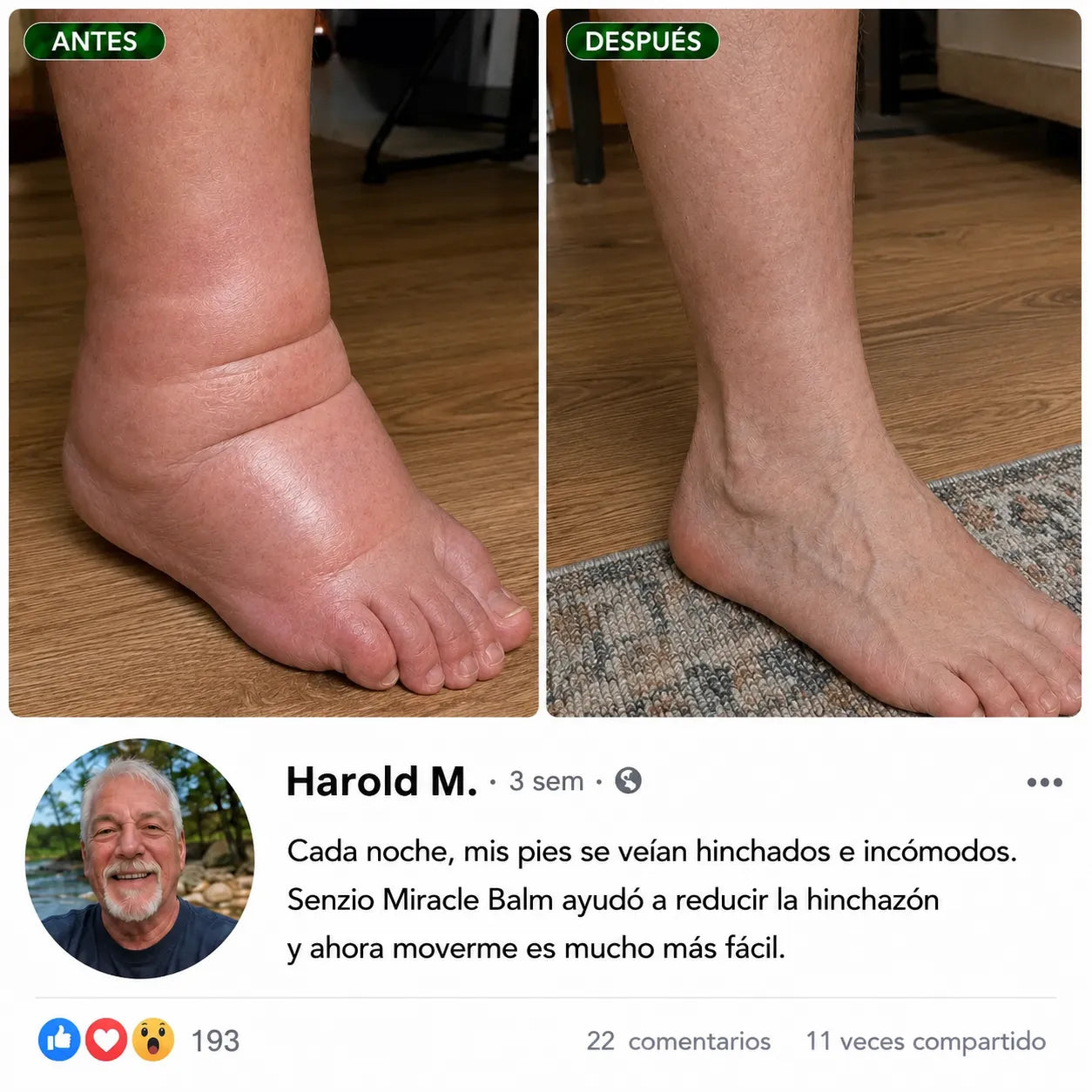 Antes y después: hinchazón de pies y tobillos