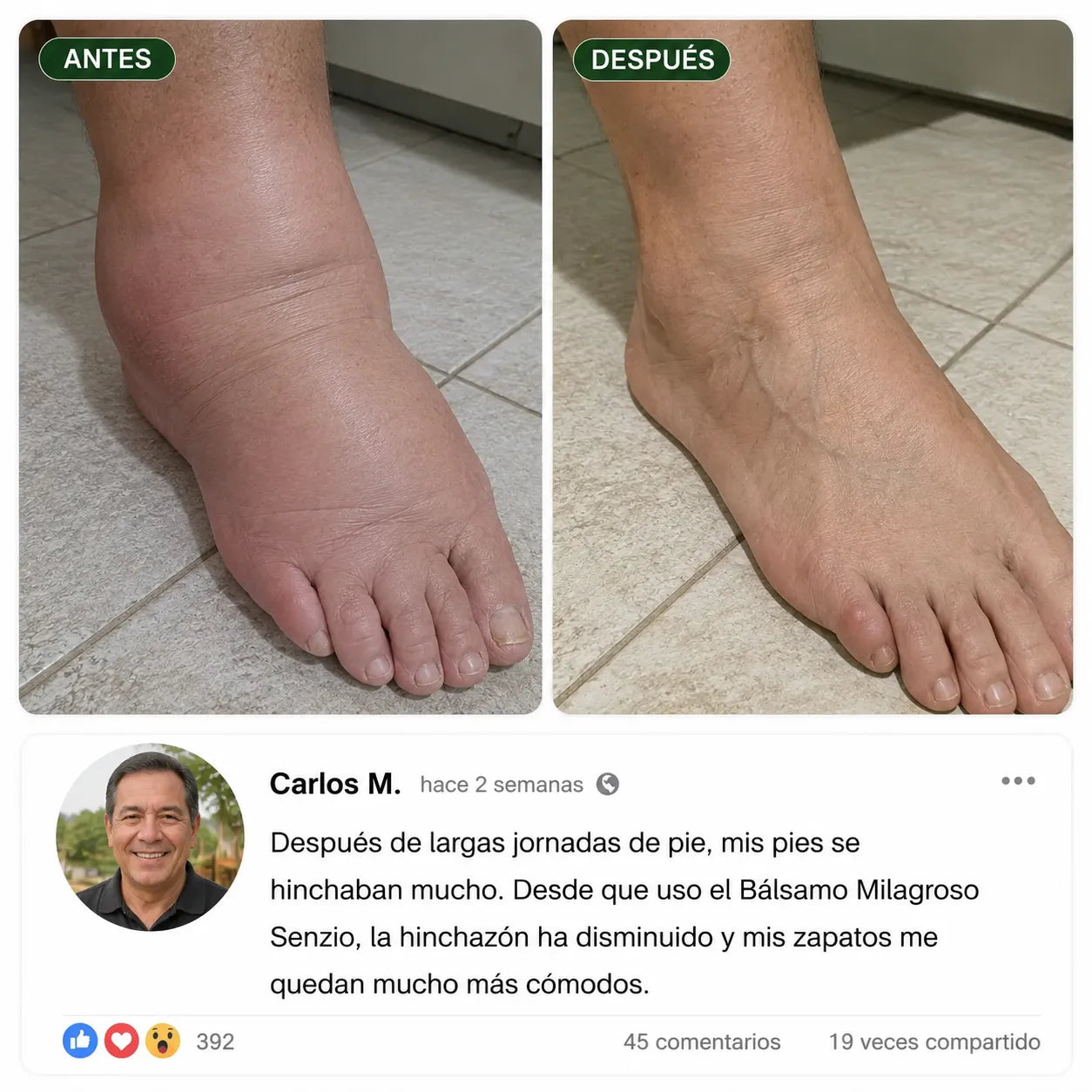 Antes y después: hinchazón de pies y tobillos